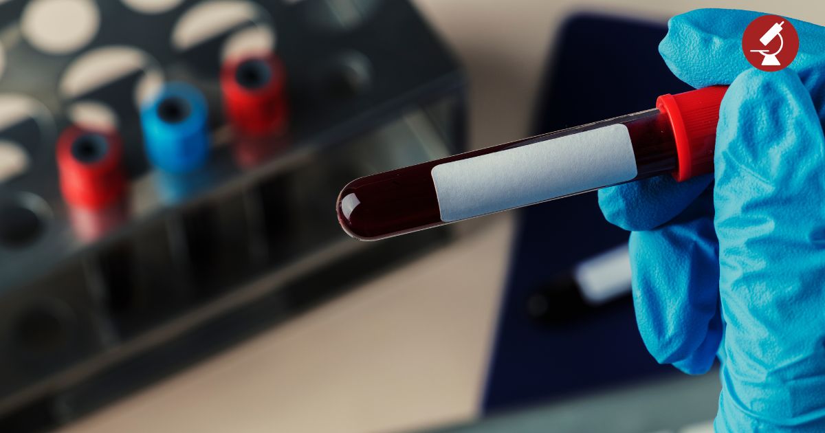 Δείγμα αίματος σε σωληνάριο για αιματολογικές εξετάσεις πριν την ανάλυση